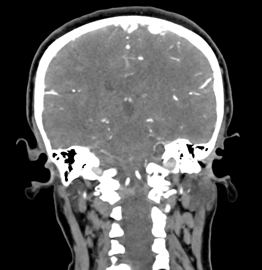 Cerebral arteriovenous malformation (Radiopaedia 73830-84645 C 60).jpg