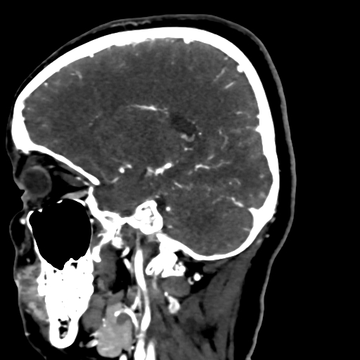 Cerebral arteriovenous malformation (Radiopaedia 73830-84645 Sagittal C+ delayed 33).jpg