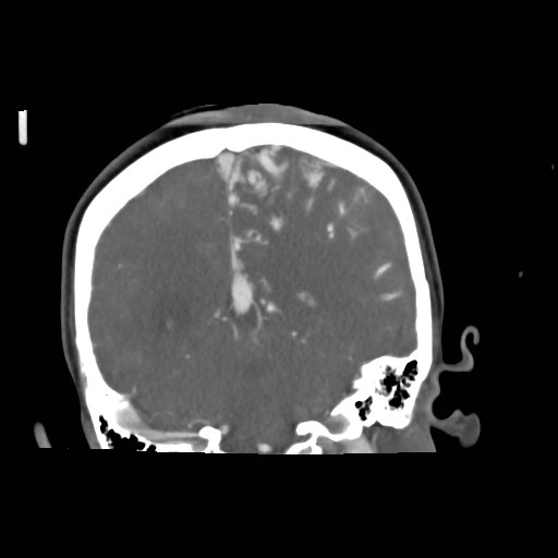 File:Cerebral arteriovenous malformation (Radiopaedia 79677-92888 B 31).jpg