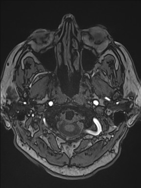 File:Cerebral arteriovenous malformation (Radiopaedia 84015-99245 Axial TOF 39).jpg