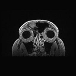Cerebral arteriovenous malformation (Radiopaedia 84015-99245 Coronal T1 C+ 17).jpg