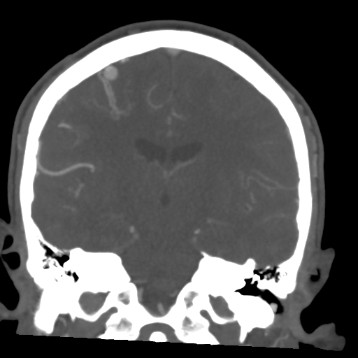 Cerebral arteriovenous malformation (Spetzler-Martin grade 2) (Radiopaedia 41262-44076 F 35).png