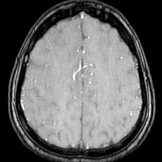 Cerebral arteriovenous malformation at posterior body of corpus callosum (Radiopaedia 74111-84925 Axial MRA 170).jpg