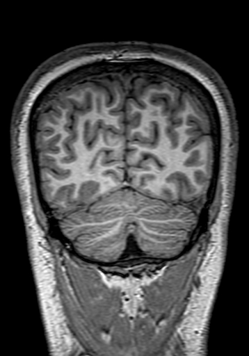 Cerebral arteriovenous malformation at posterior body of corpus callosum (Radiopaedia 74111-84925 Coronal T1 292).jpg