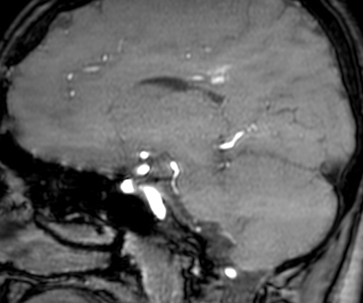 Cerebral arteriovenous malformation at posterior body of corpus callosum (Radiopaedia 74111-84925 J 163).jpg