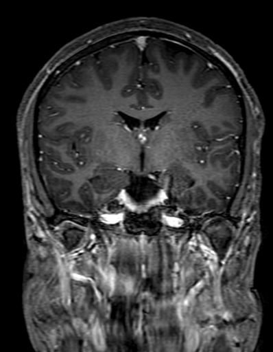Cerebral arteriovenous malformation at posterior body of corpus callosum (Radiopaedia 74111-84925 K 170).jpg