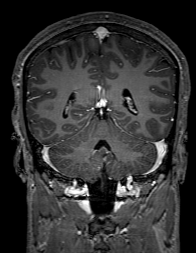 Cerebral arteriovenous malformation at posterior body of corpus callosum (Radiopaedia 74111-84925 K 254).jpg