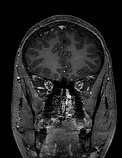 Cerebral arteriovenous malformation at posterior body of corpus callosum (Radiopaedia 74111-84925 K 87).jpg