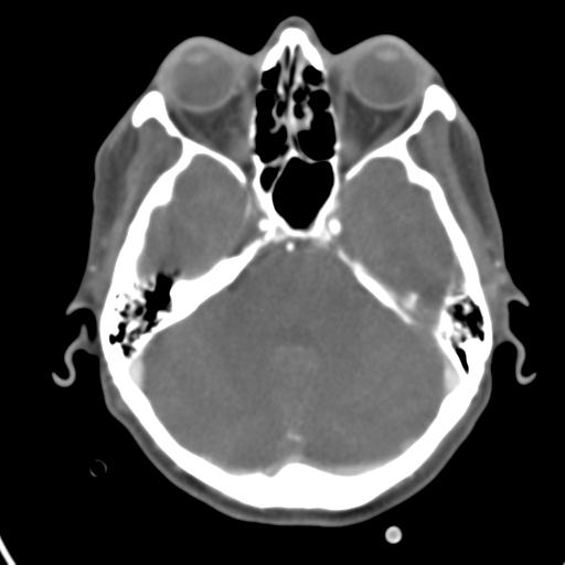 Cerebral arteriovenous malformation with hemorrhage (Radiopaedia 28773-29073 A 39).jpg