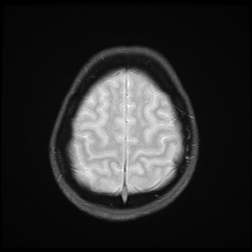 File:Cerebral autosomal dominant arteriopathy with subcortical infarcts and leukoencephalopathy (CADASIL) (Radiopaedia 41018-43768 Ax 2D MERGE 17).png