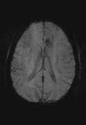 File:Cerebral cavernoma and development venous anomaly (Radiopaedia 37603-39482 Axial SWI MIP 22).png