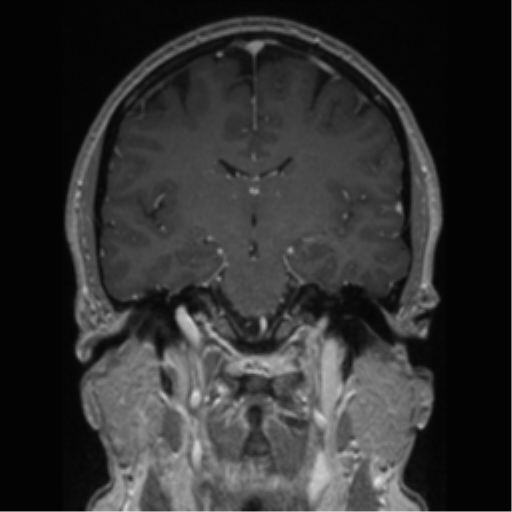 Cerebral cavernoma and development venous anomaly (Radiopaedia 37603-39482 Coronal T1 C+ 49).png