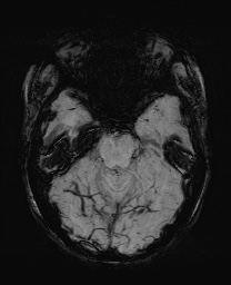 Cerebral cavernous venous malformation (Radiopaedia 70008-80021 Axial SWI 22).jpg