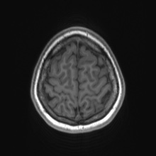 File:Cerebral cavernous venous malformation (Radiopaedia 70008-80021 Axial T1 80).jpg