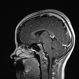 Cerebral cavernous venous malformation (Radiopaedia 70008-80021 Sagittal T1 C+ 38).jpg