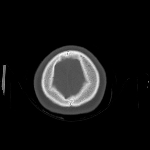 Cerebral cavernous venous malformation (Radiopaedia 70008-80022 Axial bone window 53).jpg