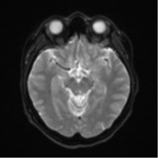 Cerebral cavernous venous malformations (Radiopaedia 48117-52946 Axial DWI 11).png