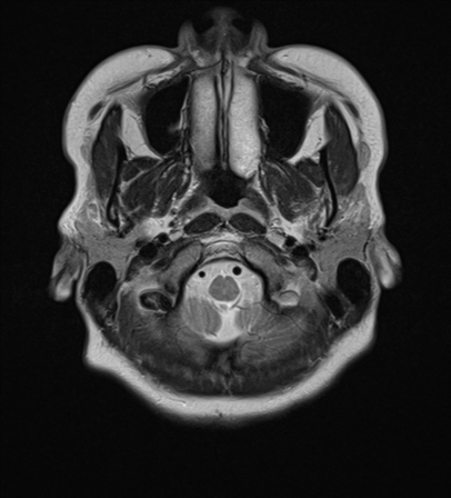 File:Cerebral cavernous venous malformations (Radiopaedia 48117-52946 Axial T2 1).png