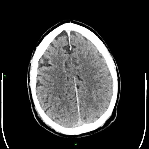 Cerebral contusions (Radiopaedia 33868-35039 Axial non-contrast 157).jpg