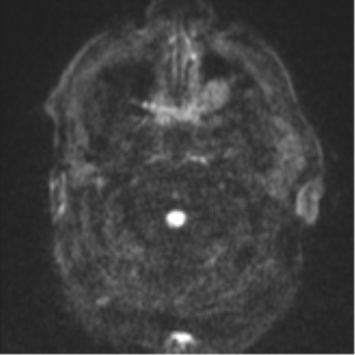 Cerebral embolic infarcts (embolic shower) (Radiopaedia 57395-64342 Axial DWI 37).png