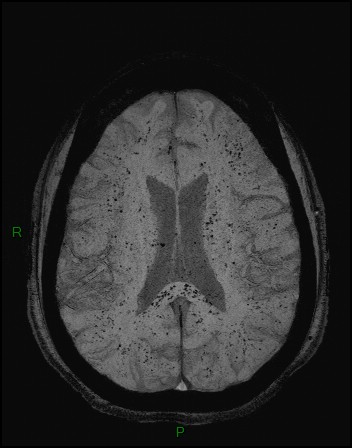Cerebral fat embolism (Radiopaedia 35022-36525 Axial SWI 29).jpg