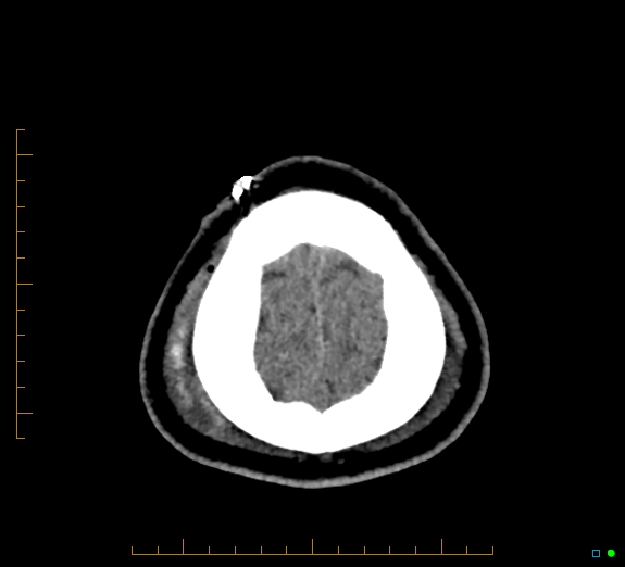 Cerebral fat embolism (Radiopaedia 85521-101224 Axial non-contrast 48).jpg
