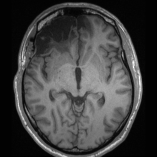 Cerebral hemorrhagic contusions- temporal evolution (Radiopaedia 40224-42757 Axial T1 35).png