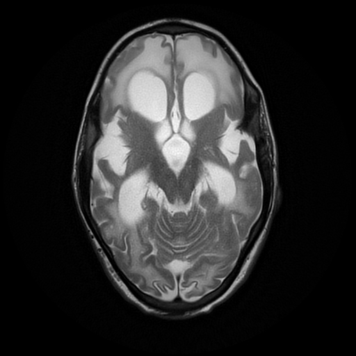 File:Cerebral manifestations of mucopolysaccharidosis type I (Radiopaedia 59171-66487 Axial T2 9).jpg