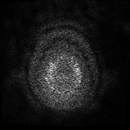 Cerebral metastases - melanoma (Radiopaedia 80972-94522 Axial DWI 63).jpg