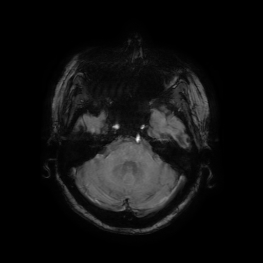 Cerebral metastases - melanoma (Radiopaedia 80972-94522 Axial SWI 26).jpg