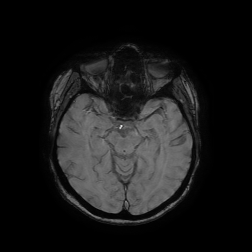 Cerebral metastases - melanoma (Radiopaedia 80972-94522 Axial SWI 41).jpg