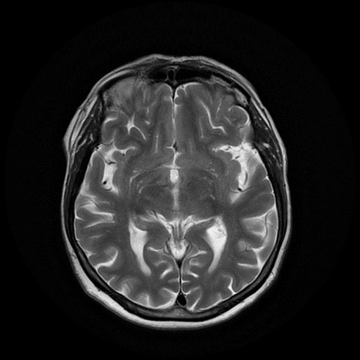 File:Cerebral metastases - melanoma (Radiopaedia 80972-94522 Axial T2 15).jpg