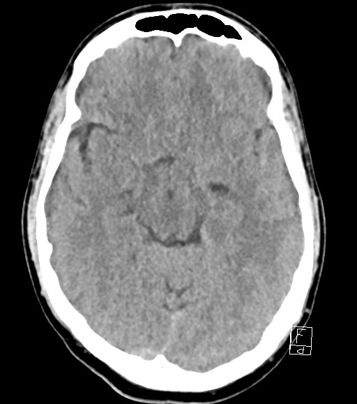 Cerebral metastases - testicular choriocarcinoma (Radiopaedia 84486-99855 Axial non-contrast 34).jpg