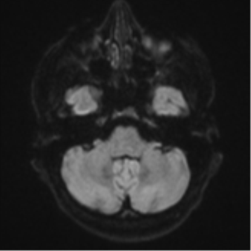 Cerebral metastasis - colorectal adenocarcinoma (Radiopaedia 50394-55765 Axial DWI 33).png
