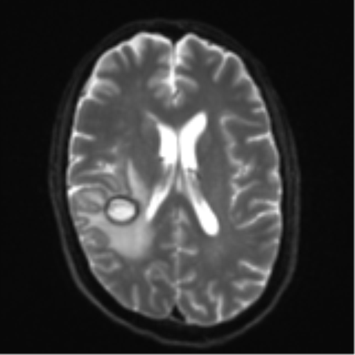 Cerebral metastasis - melanoma (Radiopaedia 54718-60954 Axial DWI 18).png