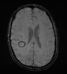 Cerebral metastasis - melanoma (Radiopaedia 54718-60954 Axial SWI 35).png