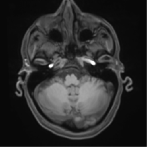 Cerebral metastasis - melanoma (Radiopaedia 54718-60954 Axial T1 13).png