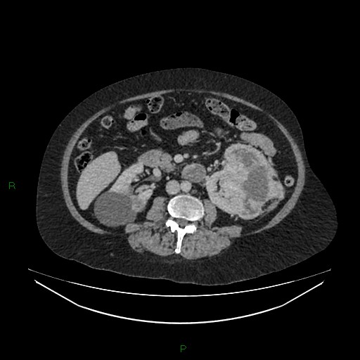 Cerebral metastasis from renal cell carcinoma (Radiopaedia 82306-96378 A 89).jpg