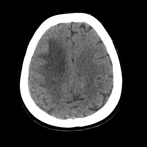 Cerebral metastasis to basal ganglia (Radiopaedia 81568-95412 Axial non-contrast 45).png