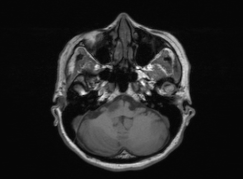 Cerebral ring enhancing lesions - cerebral metastases (Radiopaedia 44922-48817 Axial T1 309).jpg