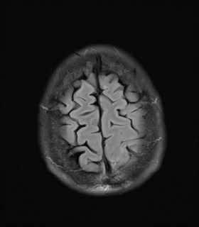 File:Cerebral toxoplasmosis (Radiopaedia 43956-47461 Axial FLAIR 20).jpg