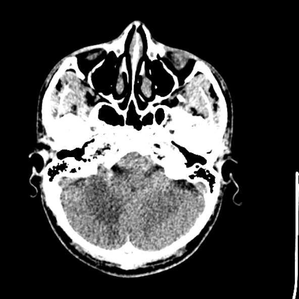 Cerebral toxoplasmosis (Radiopaedia 53993-60131 Axial non-contrast 18).jpg