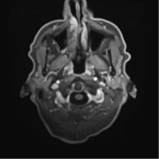 Cerebral toxoplasmosis (Radiopaedia 54575-60804 Axial T1 C+ 6).png