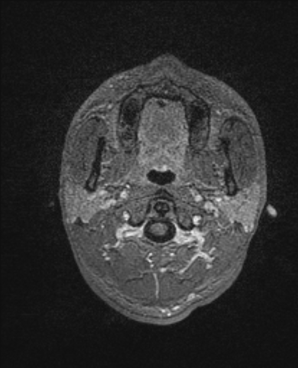 Cerebral toxoplasmosis (Radiopaedia 85779-101597 Axial T1 C+ 5).jpg