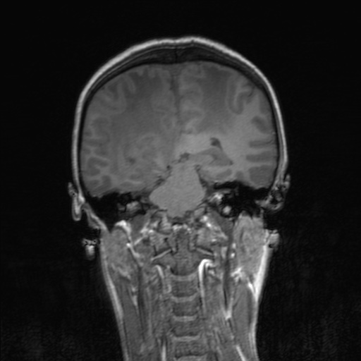 Cerebral tuberculosis with dural sinus invasion (Radiopaedia 60353-68090 Coronal T1 115).jpg