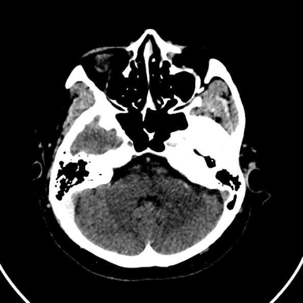 File:Cerebral venous hemorrhagic infarct from venous sinus thrombosis (Radiopaedia 55433-61883 Axial C+ delayed 114).jpg