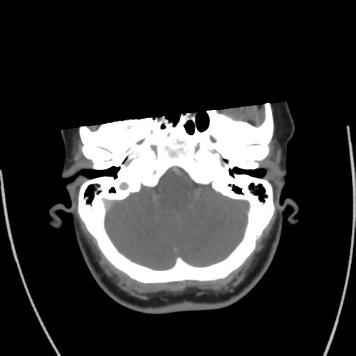 File:Cerebral venous infarct related to dural venous sinus thromboses (Radiopaedia 35292-36804 Axial C+ delayed 11).png