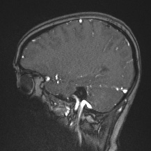 Cerebral venous infarction - hemorrhagic (Radiopaedia 81625-95505 Sagittal MRV 54).jpg