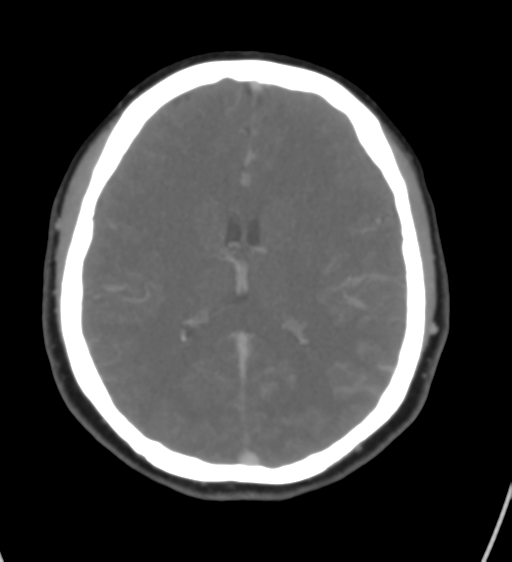 Cerebral venous infarction due to transverse sinus thrombosis (Radiopaedia 34688-36120 Axial CT venogram 30).png