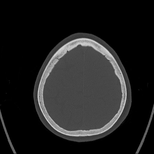 Cerebral venous infarction with hemorrhage (Radiopaedia 65343-74381 Axial bone window 157).jpg